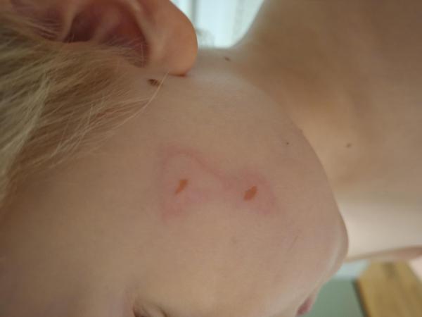 Bild zu Reaktion auf Bepathen Wundgel - Haut von Babys und Kindern ✔️ Expertenforum