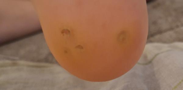 Bild zu Warzenbehandlung - Haut von Babys und Kindern ✔️ Expertenforum