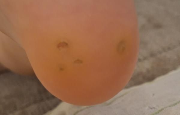 Bild zu Warzenbehandlung - Haut von Babys und Kindern ✔️ Expertenforum