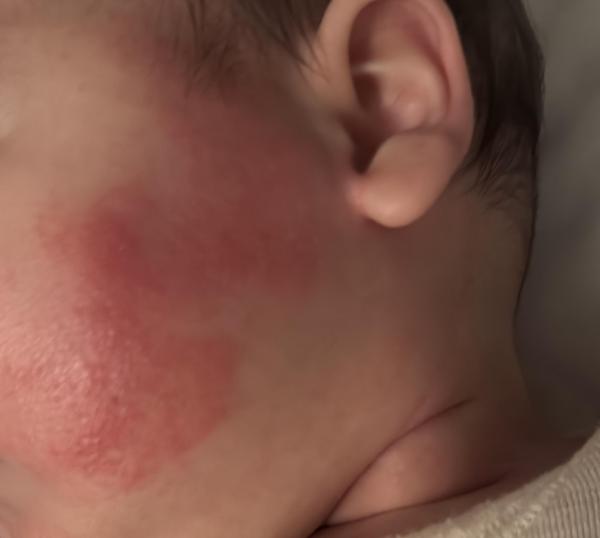 Bild zu Basispflege bei Neurodermitis 6 Monate - Haut von Babys und Kindern ✔️ Expertenforum