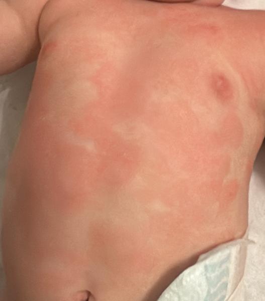 Bild zu Basispflege bei Neurodermitis 6 Monate - Haut von Babys und Kindern ✔️ Expertenforum