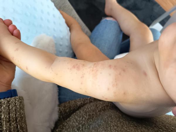 Bild zu Neurodermitis ? - Haut von Babys und Kindern ✔️ Expertenforum