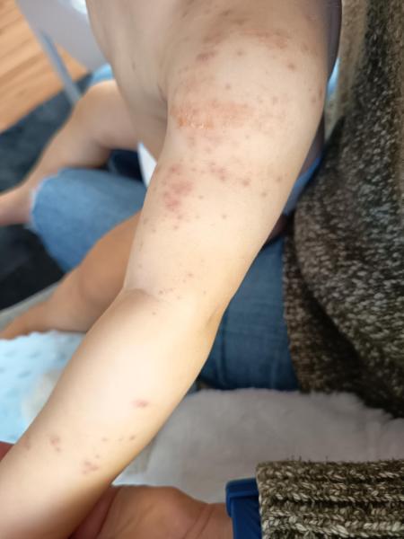 Bild zu Neurodermitis - Haut von Babys und Kindern ✔️ Expertenforum