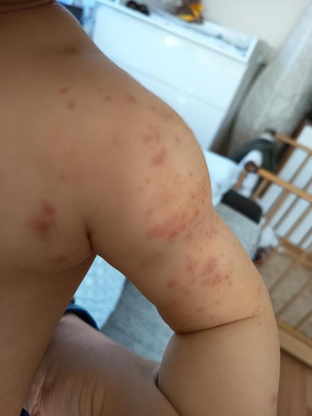 Bild zu Neurodermitis ? - Haut von Babys und Kindern ✔️ Expertenforum