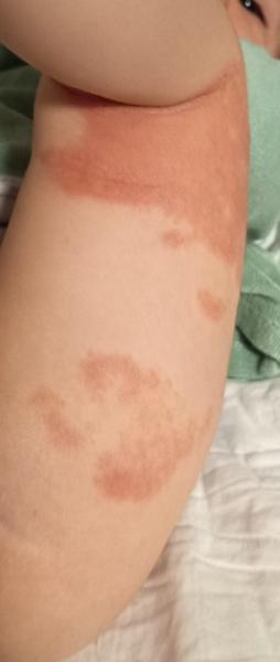 Bild zu Neurodermitis ? - Haut von Babys und Kindern ✔️ Expertenforum