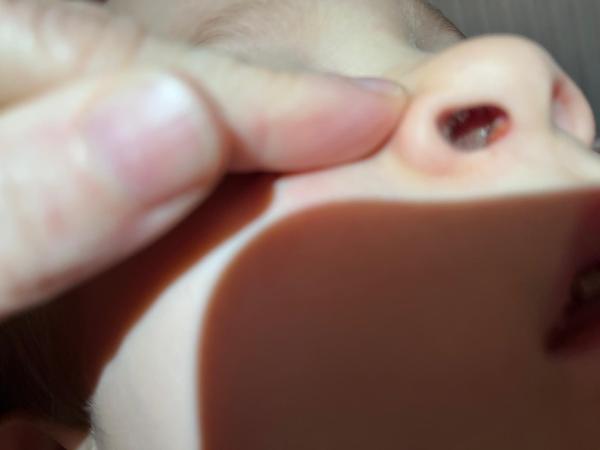 Bild zu Nasenherpes - Haut von Babys und Kindern ✔️ Expertenforum