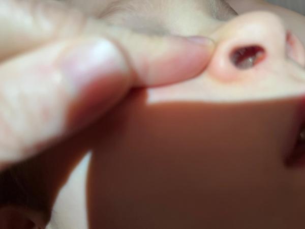 Bild zu Nasenherpes - Haut von Babys und Kindern ✔️ Expertenforum