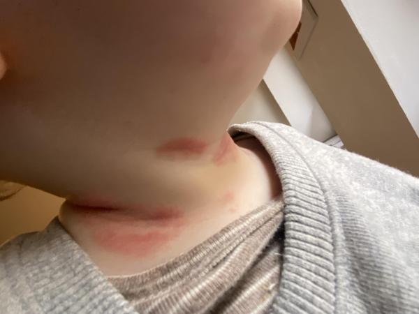 Bild zu Ist das Neurodermitis? - Haut von Babys und Kindern ✔️ Expertenforum