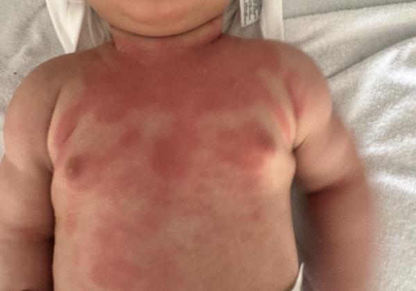 Bild zu Basispflege bei Neurodermitis 6 Monate - Haut von Babys und Kindern ✔️ Expertenforum