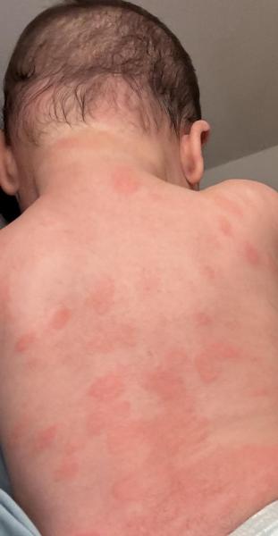 Bild zu Basispflege bei Neurodermitis 6 Monate - Haut von Babys und Kindern ✔️ Expertenforum