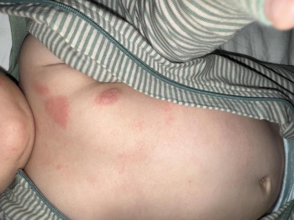 Bild zu Elidel oder Cortison - Haut von Babys und Kindern ✔️ Expertenforum