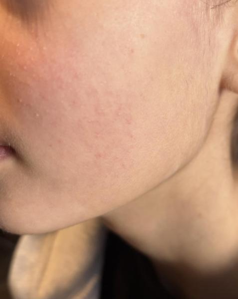 Bild zu Ausschlag Wangen bei 10jährigem Mädchen - Haut von Babys und Kindern ✔️ Expertenforum