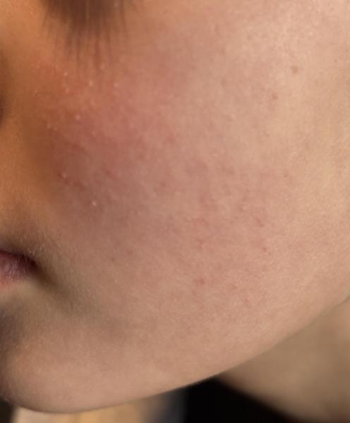 Bild zu Ausschlag Wangen bei 10jährigem Mädchen - Haut von Babys und Kindern ✔️ Expertenforum