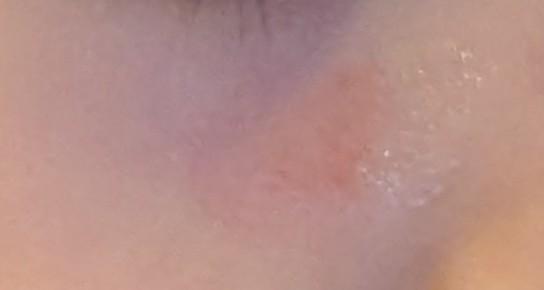 Bild zu Raue rote Stelle Gesicht - Haut von Babys und Kindern ✔️ Expertenforum