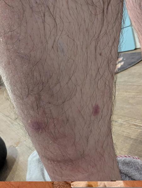 Bild zu Hautausschlag - Haut von Babys und Kindern ✔️ Expertenforum