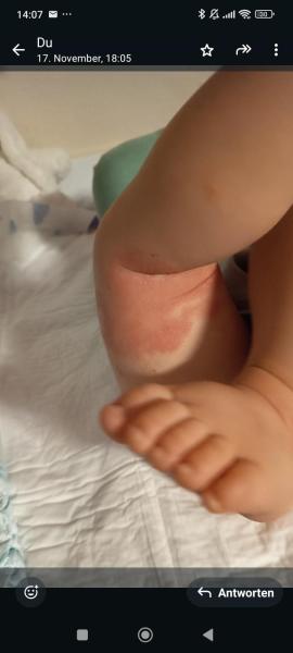 Bild zu Neurodermitis - Haut von Babys und Kindern ✔️ Expertenforum