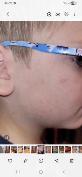 Bild zu Ausschlag bzw Pickelchen im Gesicht - Haut von Babys und Kindern ✔️ Expertenforum