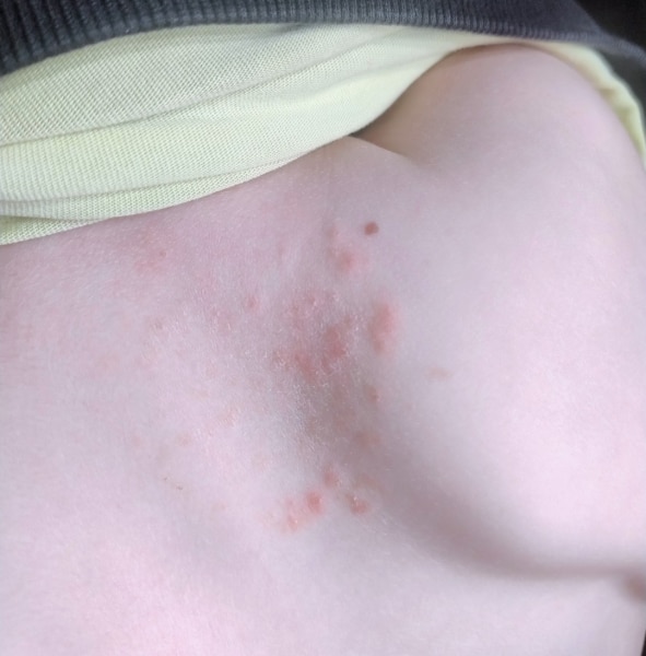 Bild zu Bild zur Frage bezüglich Terbinafin - Haut von Babys und Kindern ✔️ Expertenforum