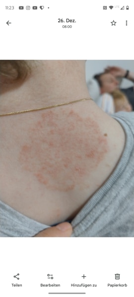 Bild zu Behandlung Haztpilz - Haut von Babys und Kindern ✔️ Expertenforum