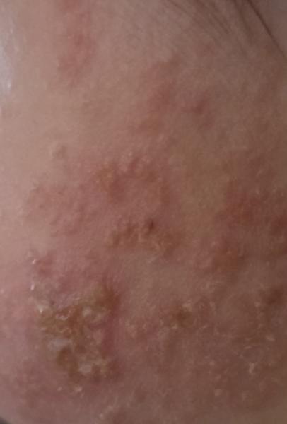 Bild zu Was könnte das sein? - Haut von Babys und Kindern ✔️ Expertenforum