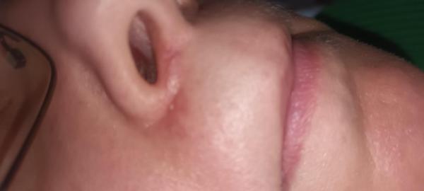 Bild zu Pickel unter dem Nasenloch - Haut von Babys und Kindern ✔️ Expertenforum