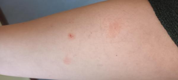 Bild zu Allergietest - Haut von Babys und Kindern ✔️ Expertenforum