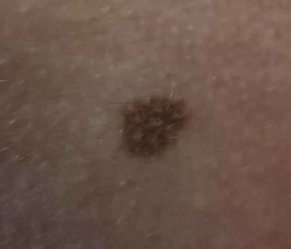 Bild zu Muttermal, Nävi? - Haut von Babys und Kindern ✔️ Expertenforum