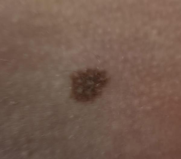 Bild zu Muttermal, Nävi? - Haut von Babys und Kindern ✔️ Expertenforum