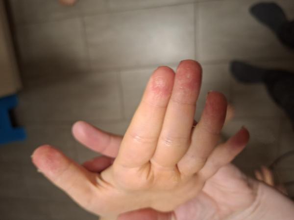 Bild zu Ausschlag - Haut von Babys und Kindern ✔️ Expertenforum