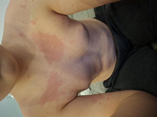 Bild zu Ausschlag - Haut von Babys und Kindern ✔️ Expertenforum