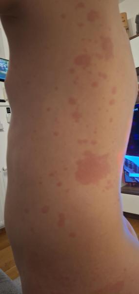 Bild zu Ausschlag - Haut von Babys und Kindern ✔️ Expertenforum