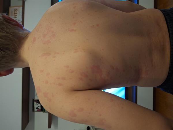 Bild zu Ausschlag - Haut von Babys und Kindern ✔️ Expertenforum