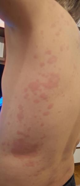 Bild zu Ausschlag - Haut von Babys und Kindern ✔️ Expertenforum