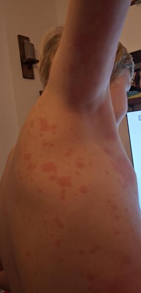 Bild zu Ausschlag - Haut von Babys und Kindern ✔️ Expertenforum