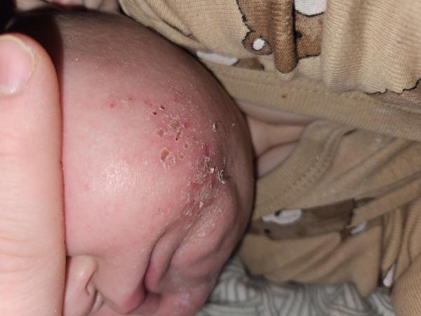 Bild zu Hautausschlag Mundbereich - Haut von Babys und Kindern ✔️ Expertenforum