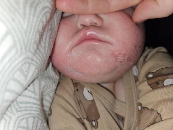 Bild zu Hautausschlag Mundbereich - Haut von Babys und Kindern ✔️ Expertenforum