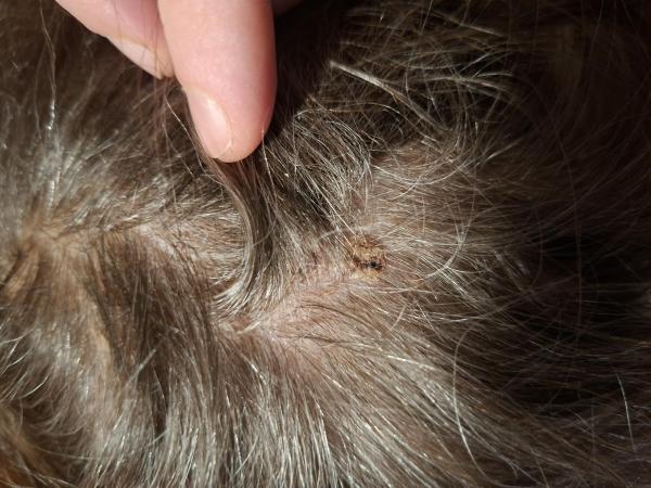 Bild zu Hautwucherung Kopfhaut - Haut von Babys und Kindern ✔️ Expertenforum