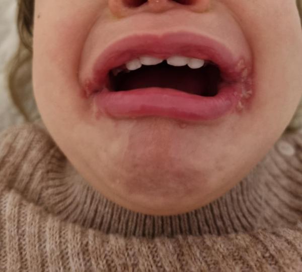 Bild zu Ausschlag um den Mund - Haut von Babys und Kindern ✔️ Expertenforum