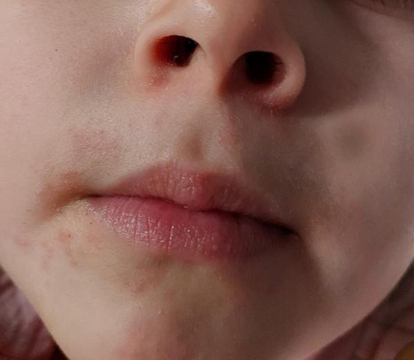 Bild zu Periorale dermatitis - Haut von Babys und Kindern ✔️ Expertenforum