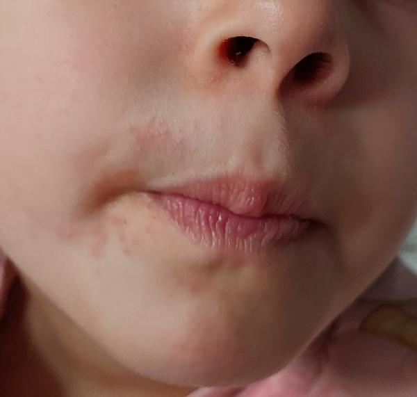 Bild zu Periorale dermatitis - Haut von Babys und Kindern ✔️ Expertenforum