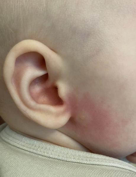 Bild zu Hautveränderungen bei meinem Kind – Bitte um dermatologische Einschätzung - Haut von Babys und Kindern ✔️ Expertenforum