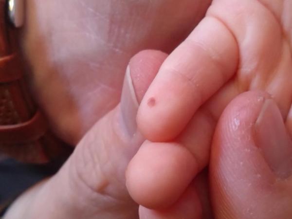 Bild zu Brauner Fleck auf Finger - Haut von Babys und Kindern ✔️ Expertenforum