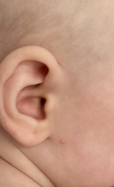 Bild zu Hautveränderungen bei meinem Kind – Bitte um dermatologische Einschätzung - Haut von Babys und Kindern ✔️ Expertenforum