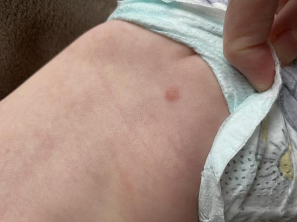 Bild zu Hautveränderungen bei meinem Kind – Bitte um dermatologische Einschätzung - Haut von Babys und Kindern ✔️ Expertenforum