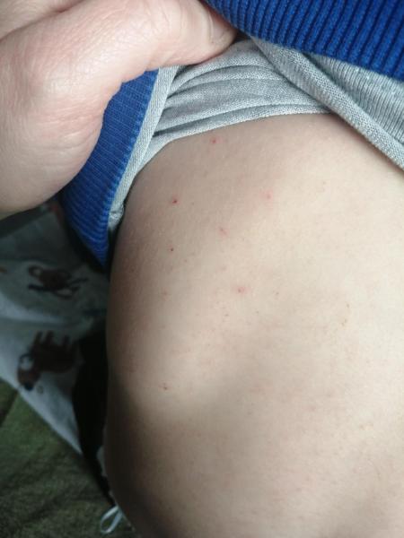 Bild zu Juckender Hautausschlag - Haut von Babys und Kindern ✔️ Expertenforum