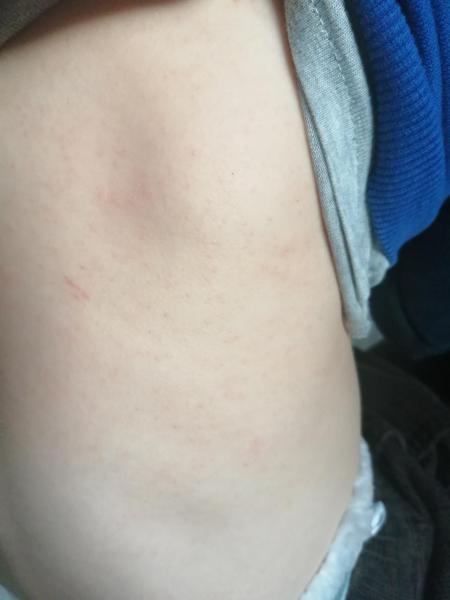 Bild zu Juckender Hautausschlag - Haut von Babys und Kindern ✔️ Expertenforum