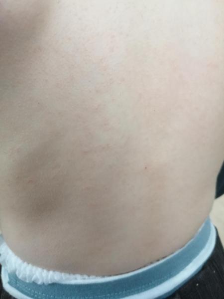 Bild zu Hautausschlag - Haut von Babys und Kindern ✔️ Expertenforum