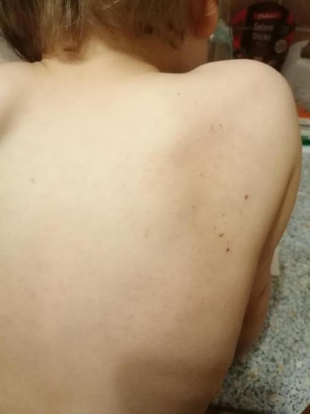 Bild zu Juckender Hautausschlag - Haut von Babys und Kindern ✔️ Expertenforum