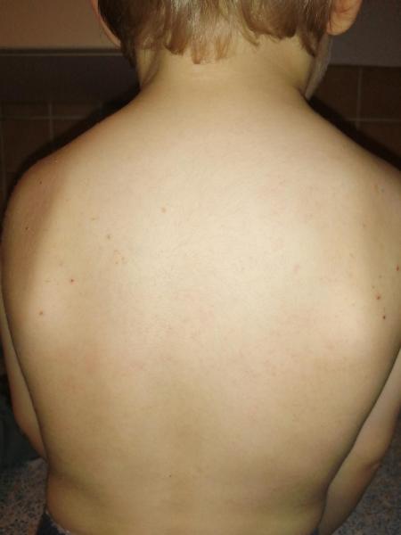 Bild zu Juckender Hautausschlag - Haut von Babys und Kindern ✔️ Expertenforum