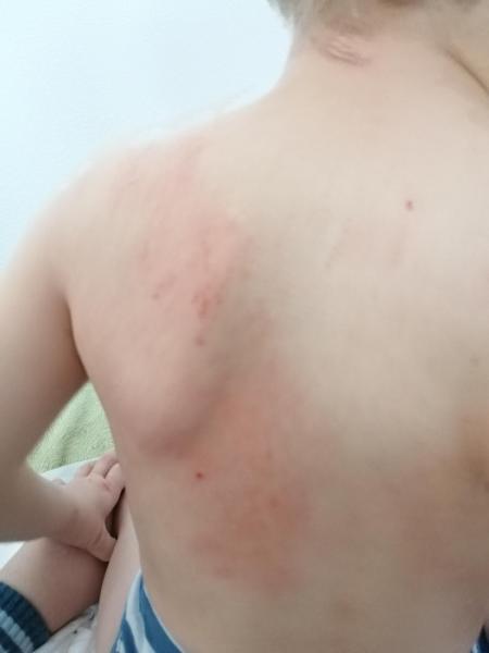 Bild zu Hautausschlag - Haut von Babys und Kindern ✔️ Expertenforum